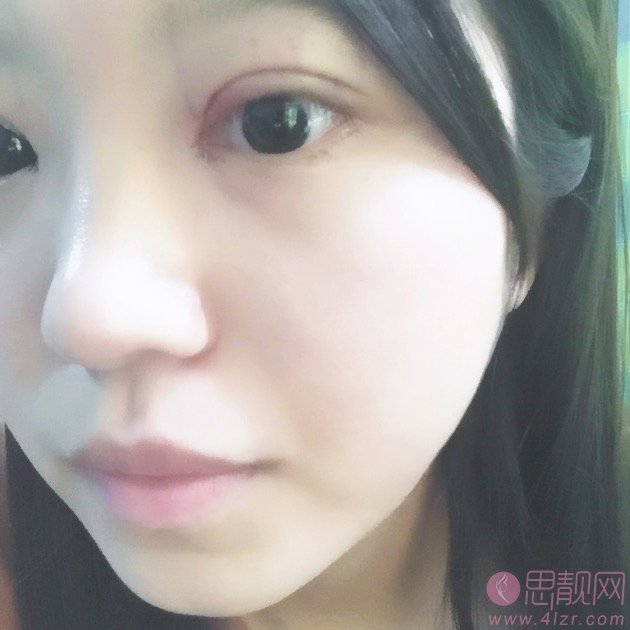 郑州东方女子医院做双眼皮怎么样?附双眼皮案例及2020价格表隆重发布