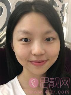 广州美莱陈贵宗双眼皮做得怎么样？附价格表一览及双眼皮案例真人反馈