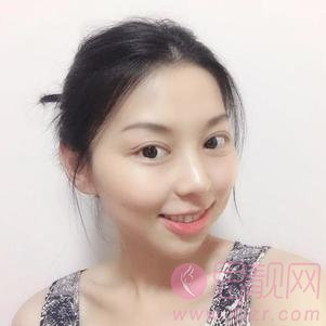 广州美莱陈贵宗双眼皮做得怎么样？附价格表一览及双眼皮案例真人反馈