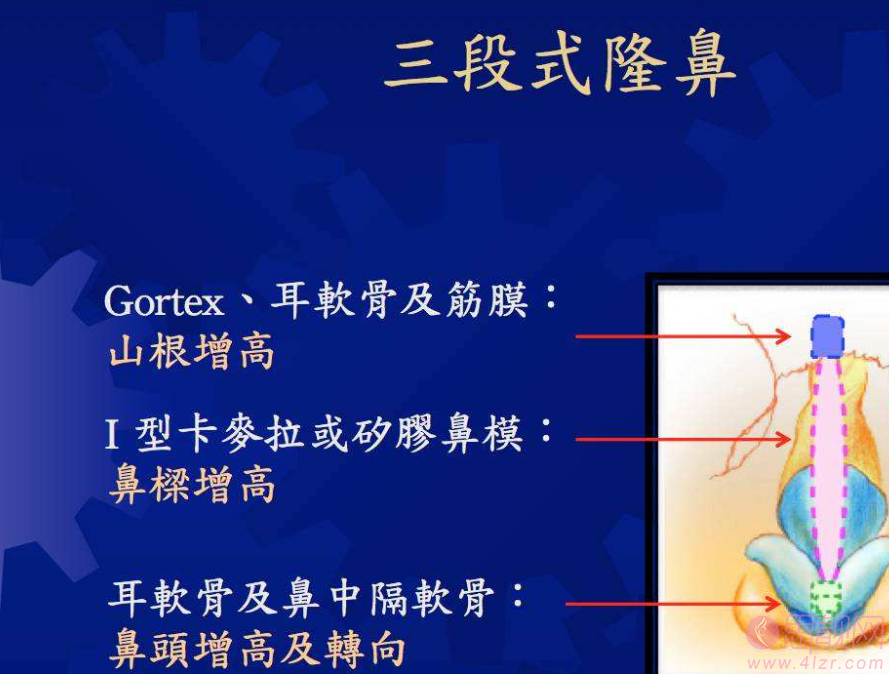 科普|韩式三段隆鼻能保持多久？