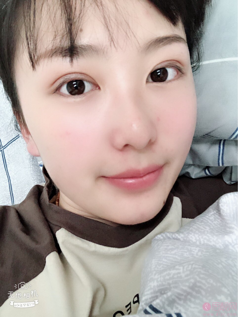 上海美莱何祥龙做双眼皮怎么样?附双眼皮案例及2020价格表一览