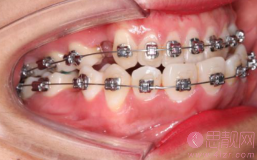 郑州拜博口腔医院怎么样？附正畸案例反馈及2020价格表公开