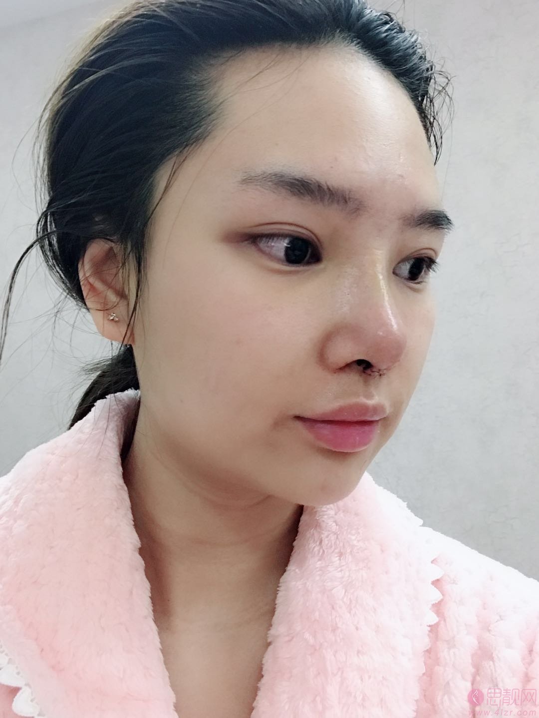 武汉美莱整形医院隆鼻如何？附隆鼻真人案例一览+2020价格表分享