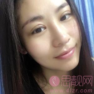 成都美莱黄小林做双眼皮怎么样？附双眼皮真人分享及2020价格表发布