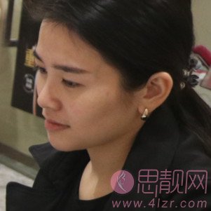 广州韩后整形崔东隆鼻怎么样?附隆鼻真人案例反馈+2020价格表曝光