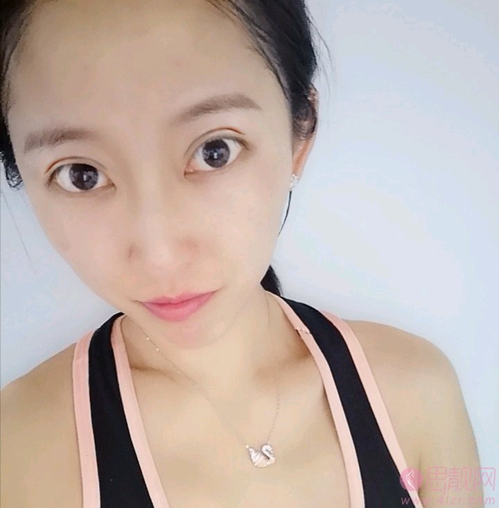 宁波美莱喻正虹做双眼皮怎么样？附双眼皮案例一览+2020价格表公布