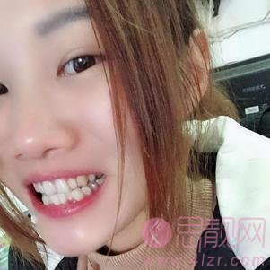 上海华美医院整牙怎么样？2020价格表明细一览+牙齿矫正案例分享