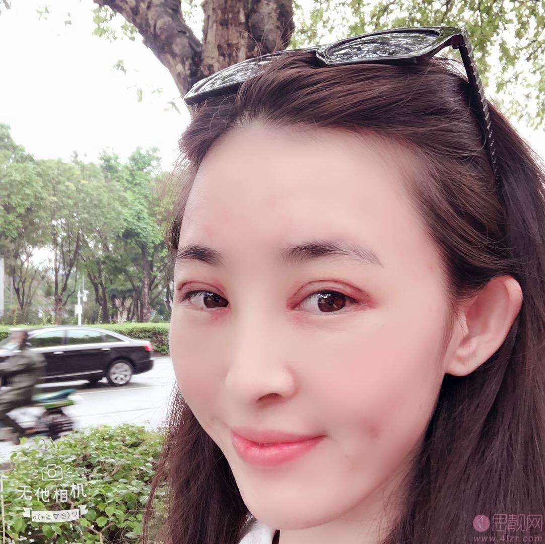 北京彤美刘风卓眼修复贵吗？附价格表及案例一览