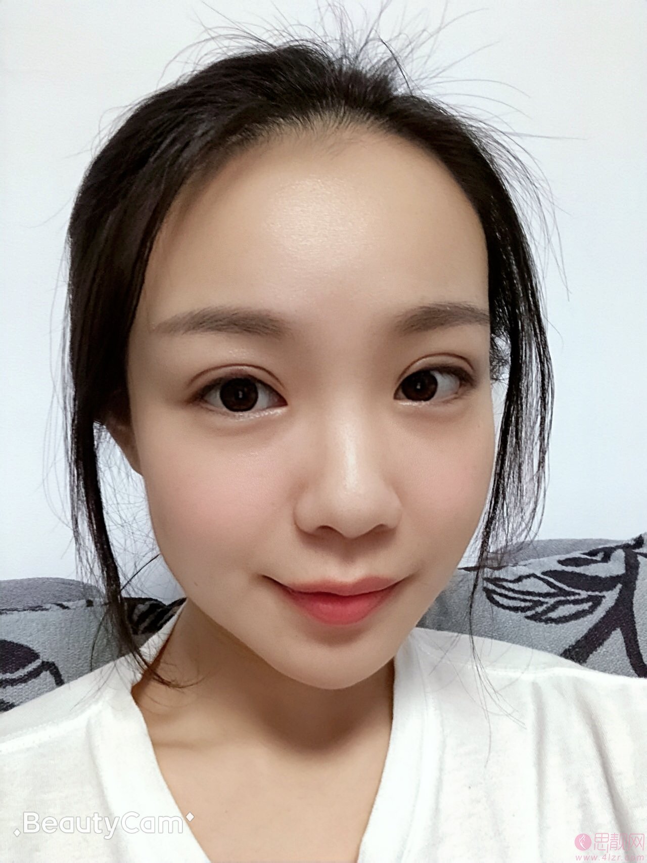 广州美莱医疗美容蒙喜永医生做双眼皮怎么样？好不好？附双眼皮真人案例分享及2020价格表一览