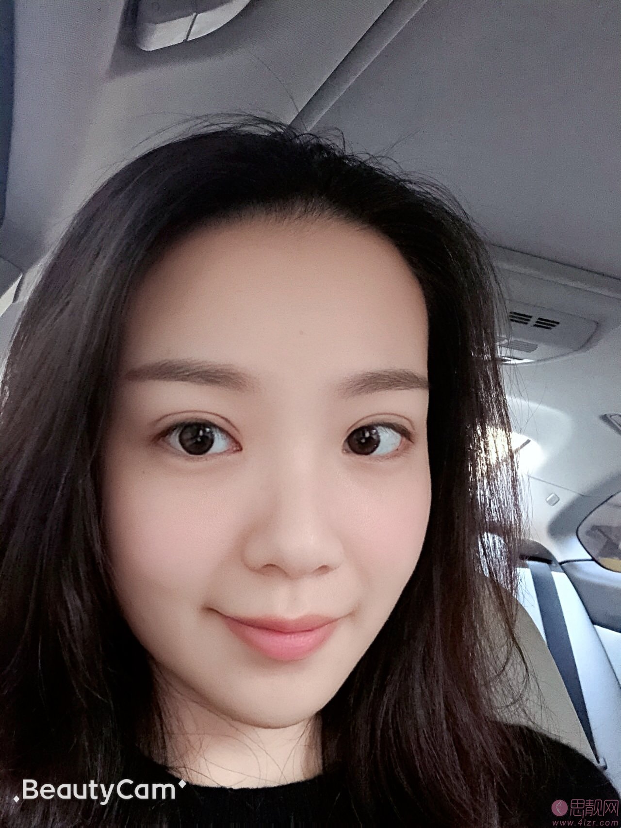 广州美莱医疗美容蒙喜永医生做双眼皮怎么样？好不好？附双眼皮真人案例分享及2020价格表一览