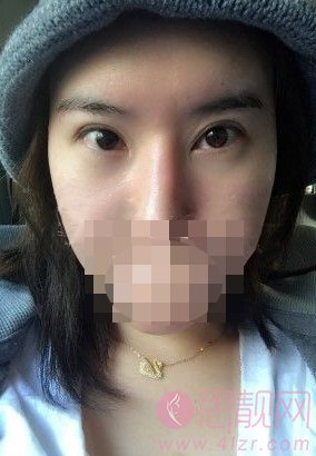 成都美绽美整形美容医院张小虎修复双眼皮如何？附案例分享+2020价格表公布