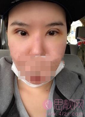 成都美绽美整形美容医院张小虎修复双眼皮如何？附案例分享+2020价格表公布