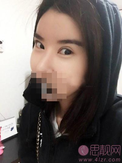 成都美绽美整形美容医院张小虎修复双眼皮如何？附案例分享+2020价格表公布