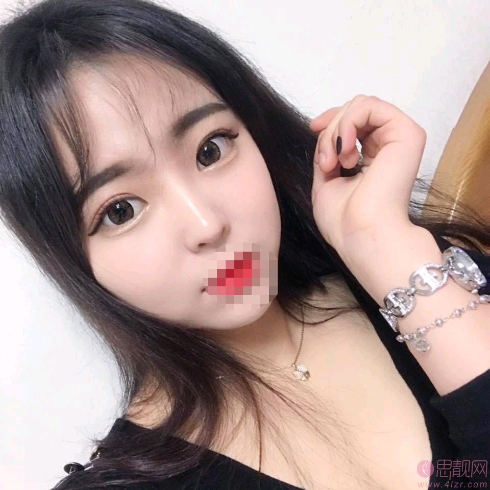 成都美绽美整形美容医院张小虎修复双眼皮如何？附案例分享+2020价格表公布