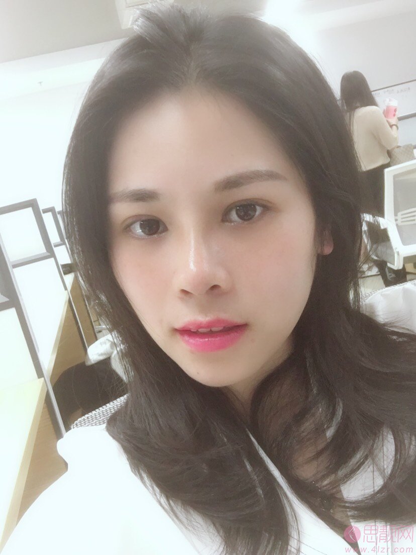 郑州美莱整形张芳医生做双眼皮怎么样？附双眼皮真人案例及2020年价格表一览