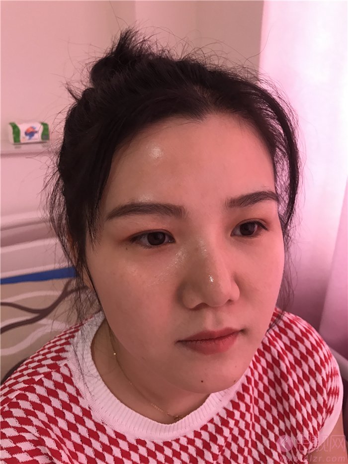 成都美上美医疗美容冉小林鼻修复怎么样？附案例及价格表明细一览