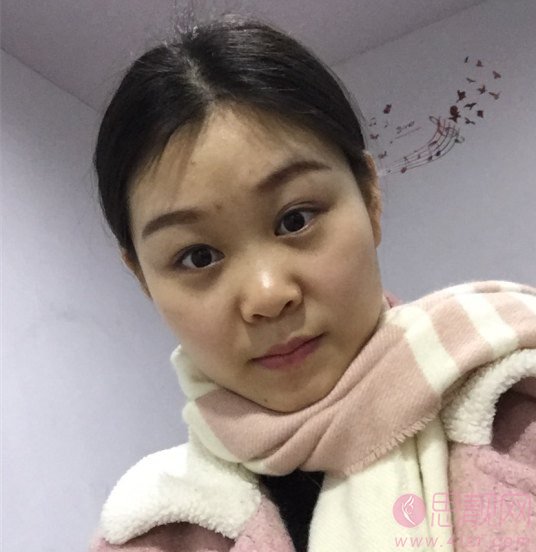 成都润美玉之光医疗美容黄开亮隆鼻如何？附隆鼻真人案例反馈及2020年价格表发布