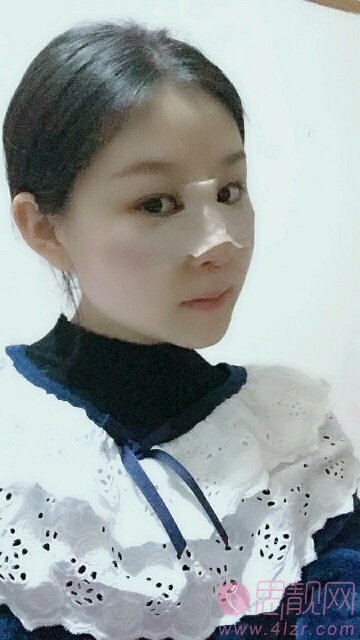 成都润美玉之光医疗美容黄开亮隆鼻如何？附隆鼻真人案例反馈及2020年价格表发布