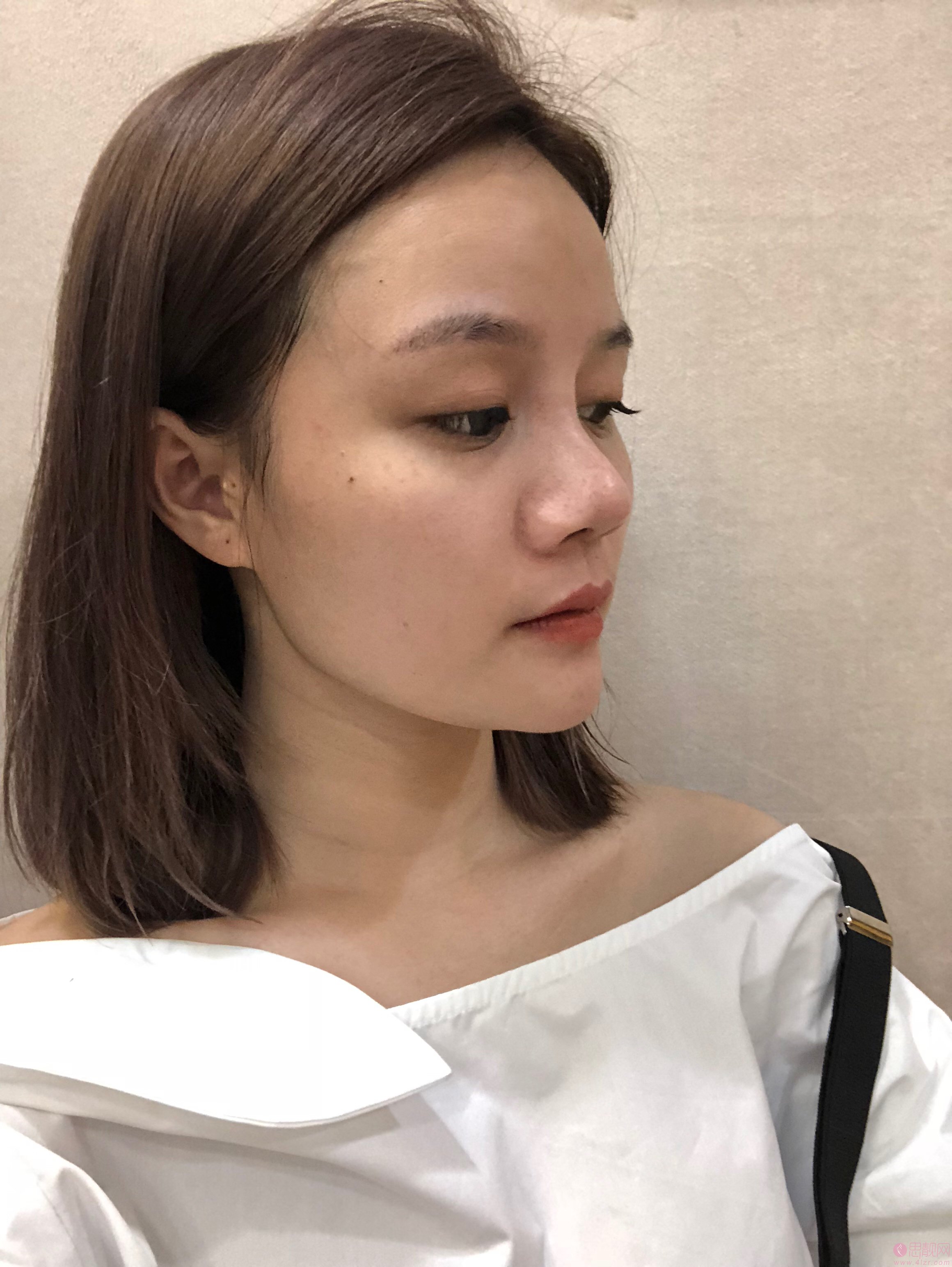 深圳美瑞儿医疗美容做隆鼻怎么样？附隆鼻案例及2020年价格表发布