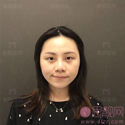 上海春藤医疗美容做双眼皮手术怎么样？附案例及2020年价格表公布