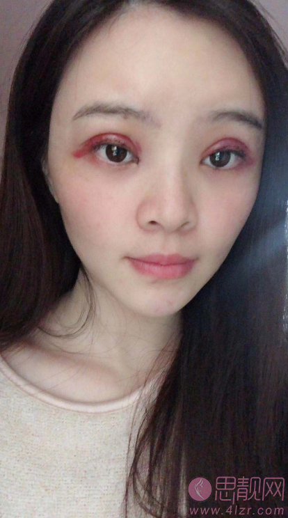 深圳美莱陈磊医生割双眼皮如何？附案例及2021年价格表一览