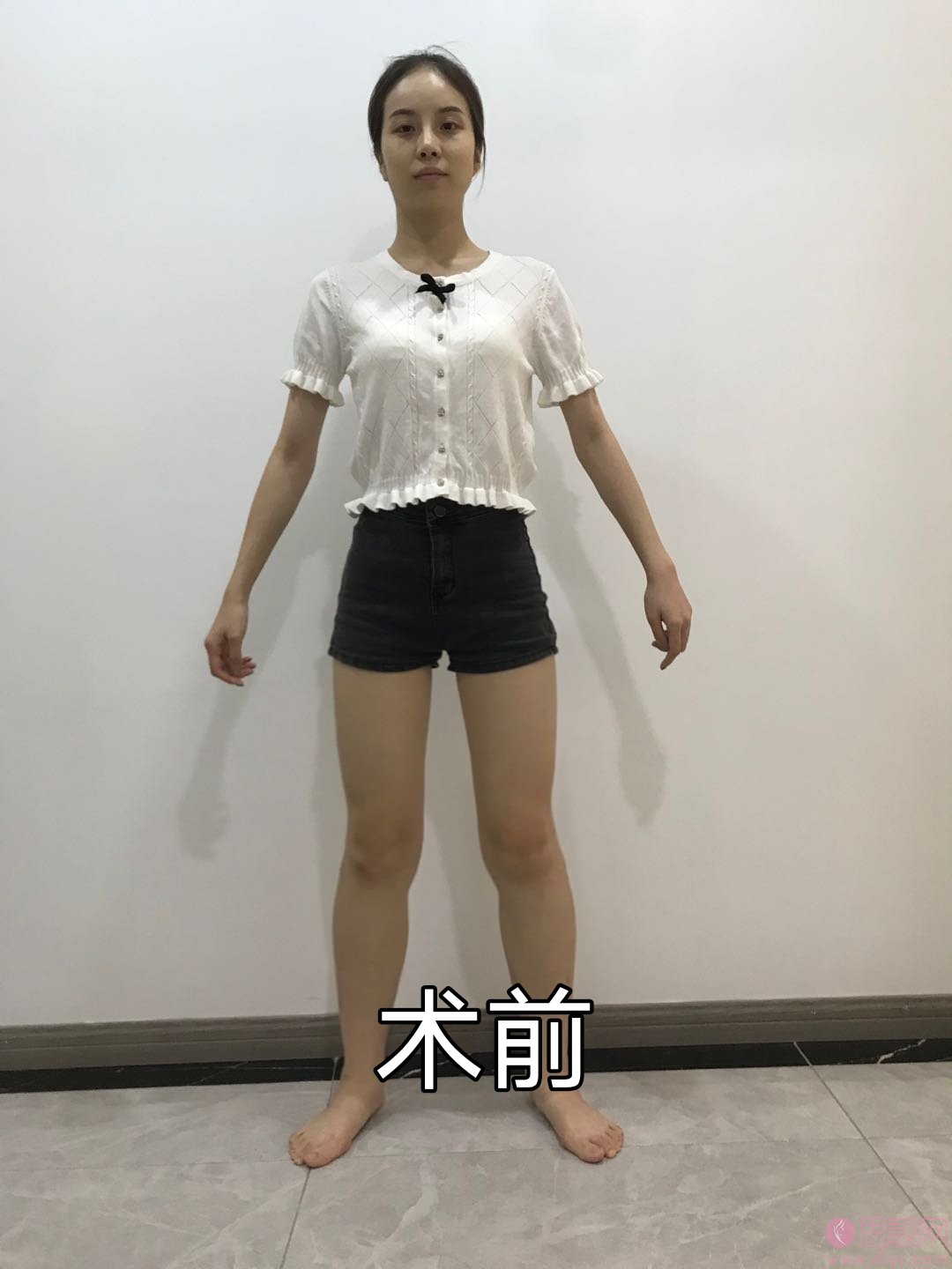 上海美希卓馨医疗美容医院抽脂怎么样？附案例分享+2021年价格表曝光