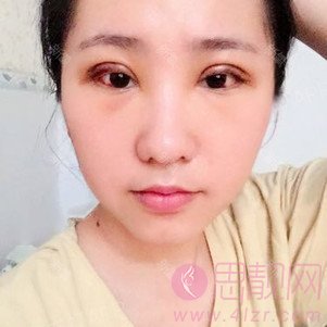 苏州卫康美容医院汪松林医生做双眼皮如何？附价格表及案例分享