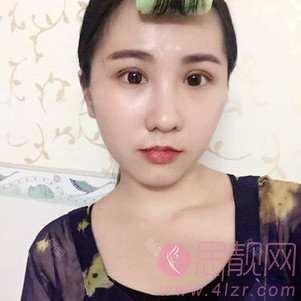 苏州卫康美容医院汪松林医生做双眼皮如何？附价格表及案例分享