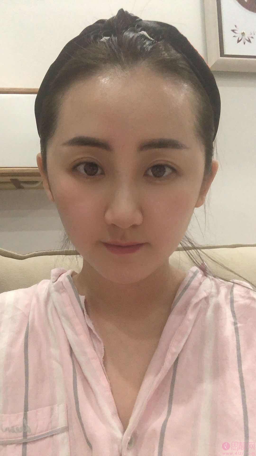 哈尔滨华美医疗美容激光除皱术