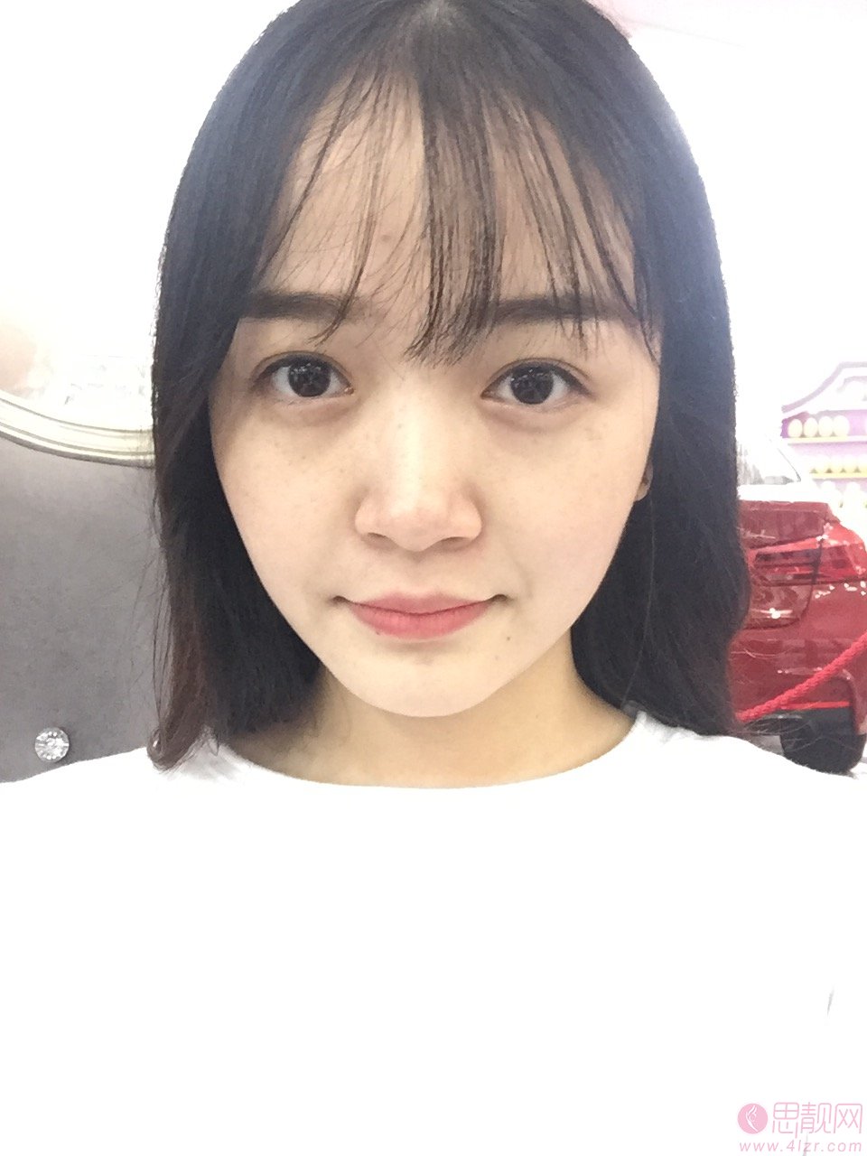 广州美莱医疗美容刘豪隆鼻怎么样？隆鼻案例分享+2021年价格表公开