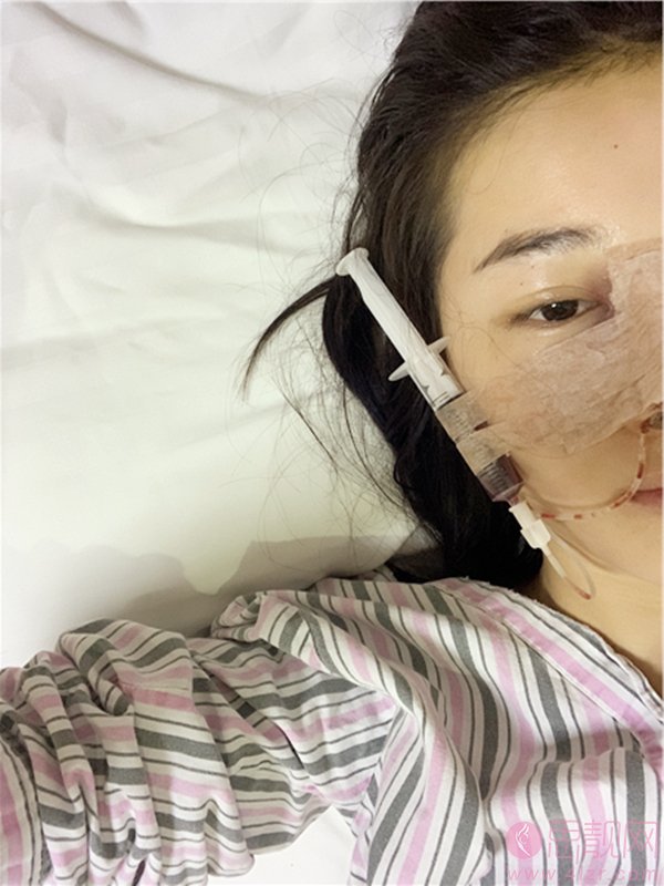 苏州美莱美容医院张亮自体软骨垫鼻尖案例