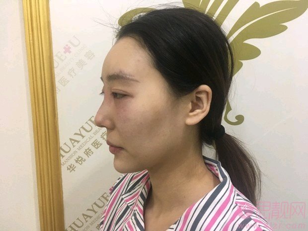 北京华悦府医疗美容医院朱燕隆鼻怎么样？附隆鼻真人案例分享+2021年价格表发布