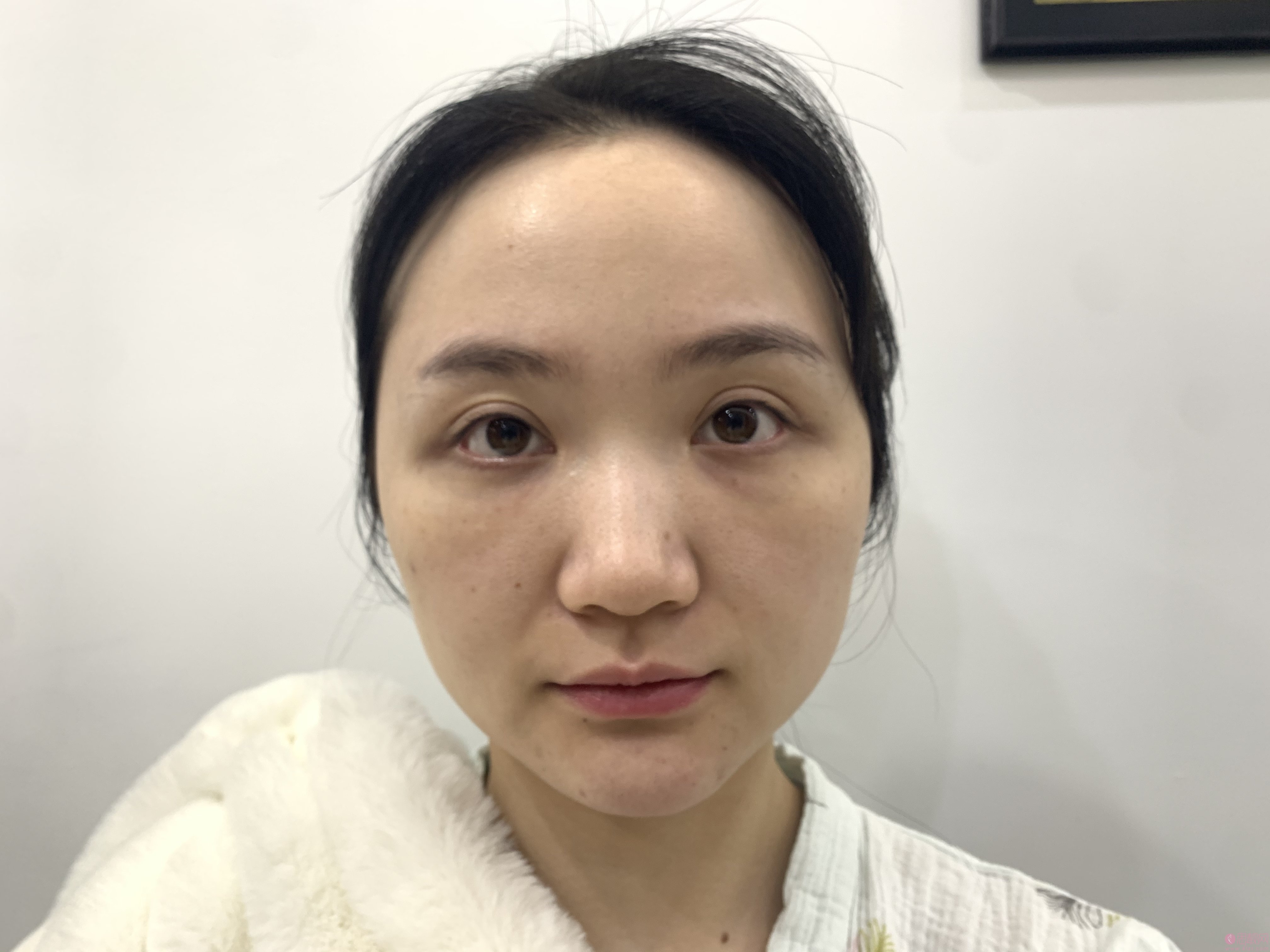 四川华美紫馨医学美容医院隆鼻案例术后真人案例分享+2021年价格表发布