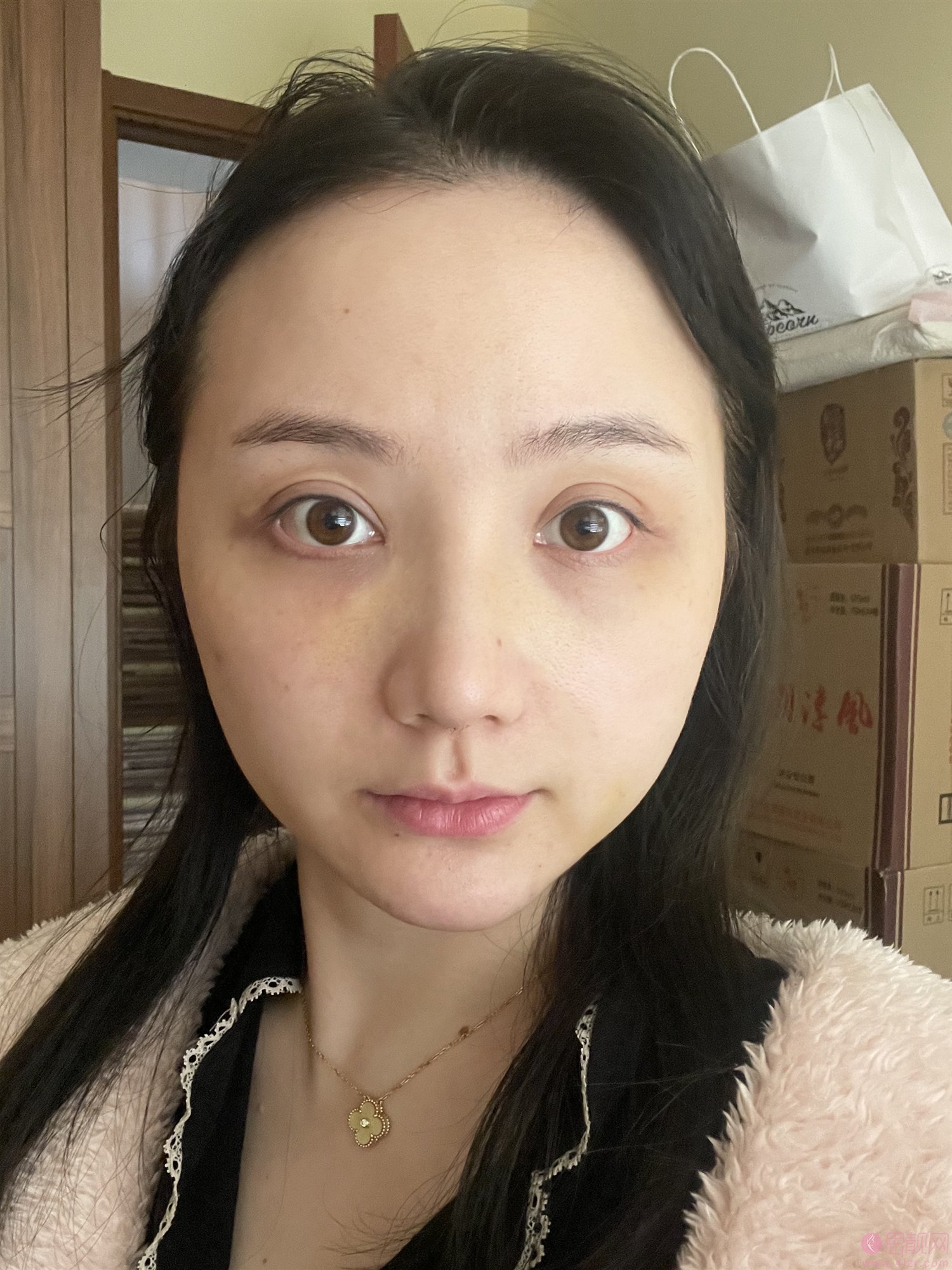 四川华美紫馨医学美容医院隆鼻案例术后真人案例分享+2021年价格表发布