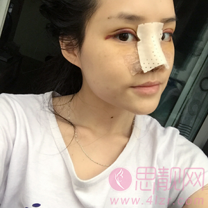 杭州格莱美医疗美容医院2021年价格表曝光+隆鼻案例前后效果对比