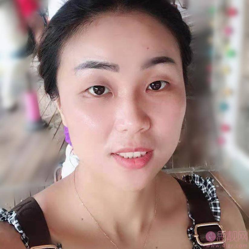 新疆伊丽莎白美容医院2021年价格表发布+双眼皮真人案例分享