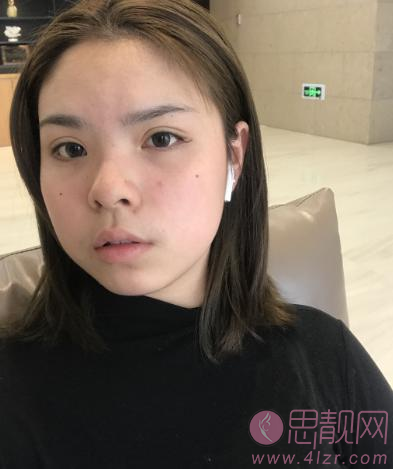 四川华美紫馨医院热玛吉多少钱？真人案例反馈+价格表参考