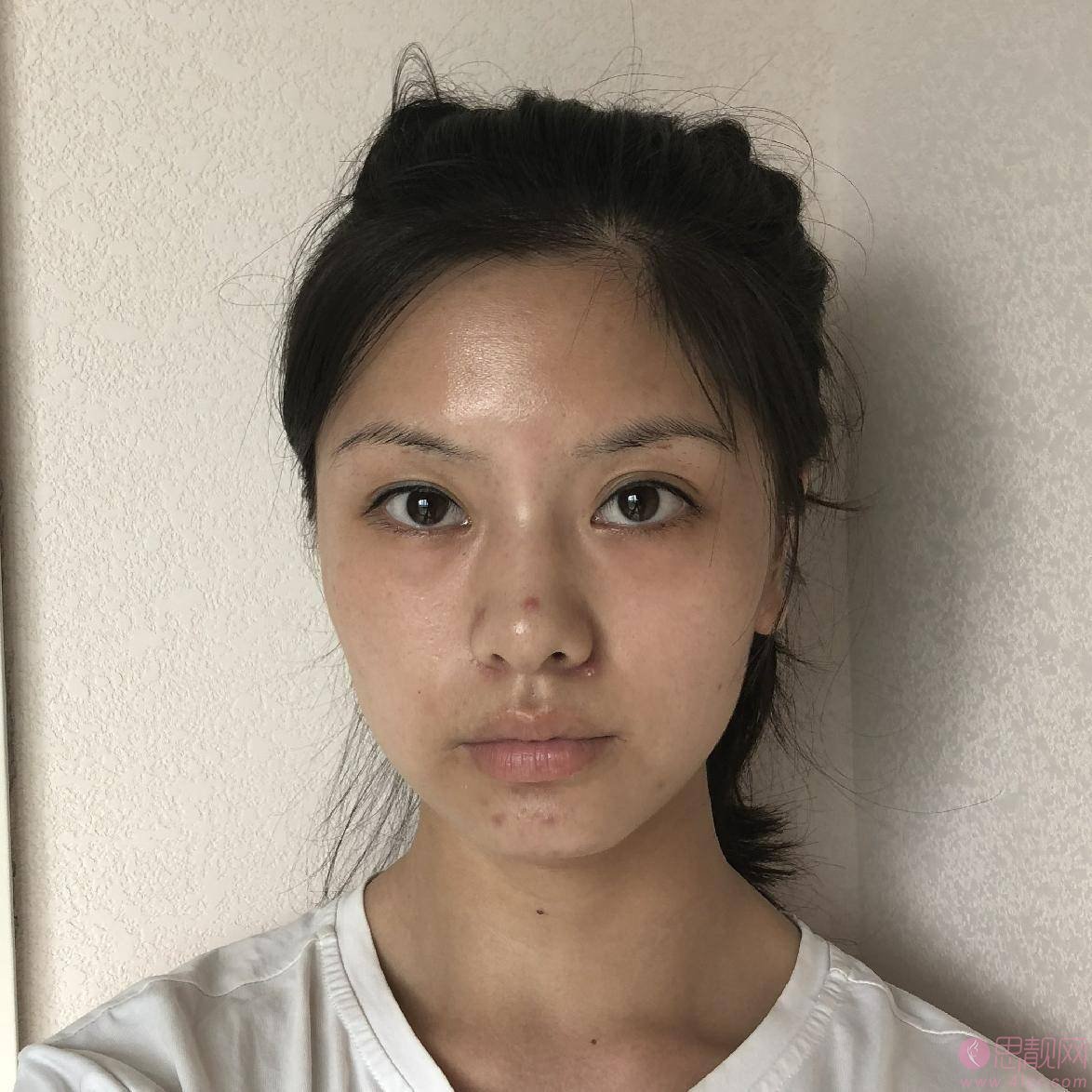 长沙美莱整形医院怎么样？正规吗？2021价格表曝光+光子嫩肤术后真人案例分享