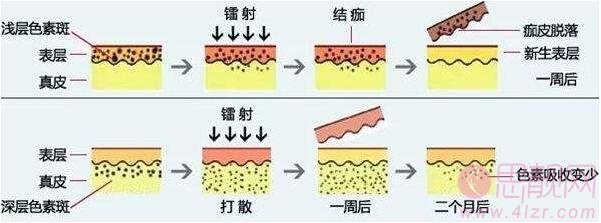 皮秒祛斑和激光去斑有什么区别