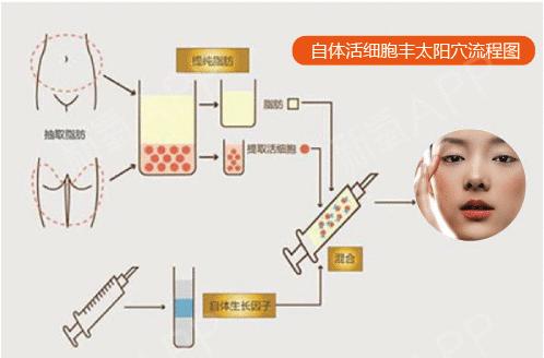 自体脂肪填充太阳穴术后照片对比