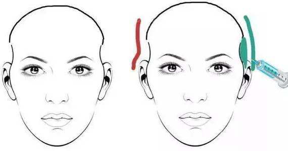 自体脂肪填充太阳穴术后照片对比