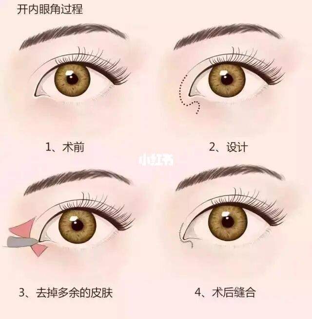 开眼角和不开眼角有什么区别呢