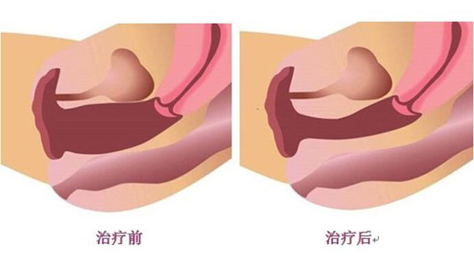 关于私密整形你了解多少