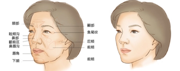 面部填充都可以填充面部的哪些部位呢