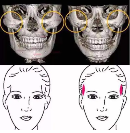 什么是颧骨内推手术效果怎样