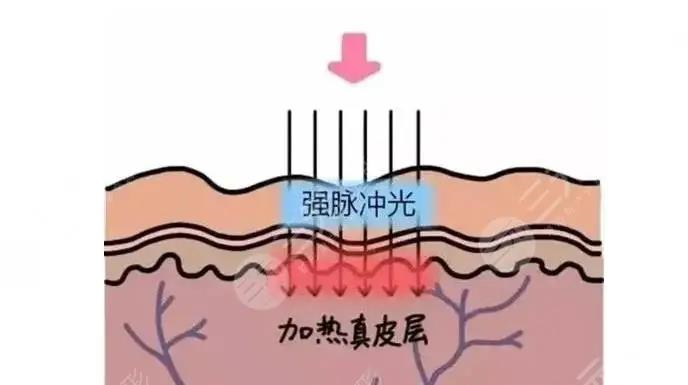 光子嫩肤的效果好吗是否需要隔一段时间就做一次