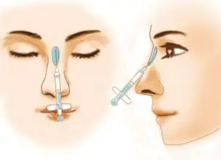 注射隆鼻的注射物可以取出吗效果好不好