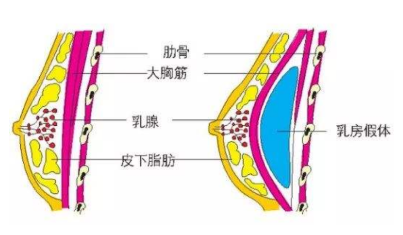 求美者是否知道什么是自体脂肪隆胸呢