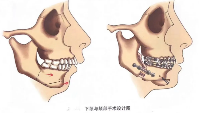 您对牙齿骨劈开术具体情况了解多少呢