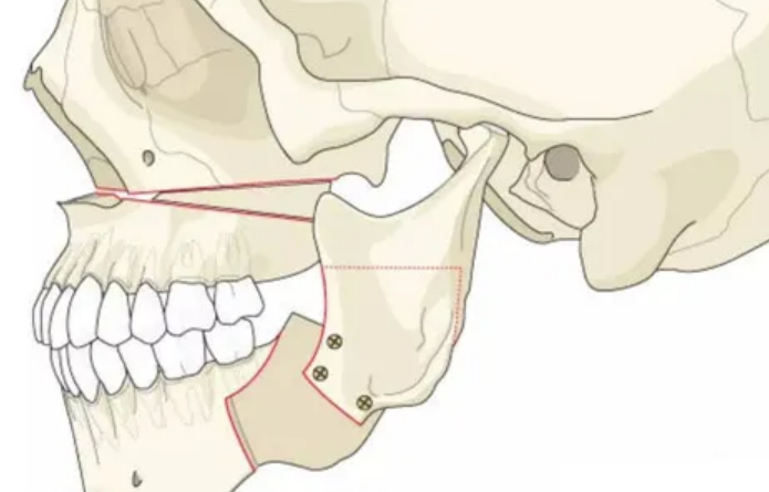 正颌外科医院排名：值得信赖的3家磨骨机构！